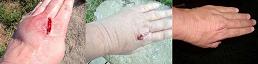 A Horse-Kick to the Hand Heals Rapidly with Quantum-Touch