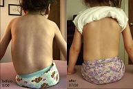 Spinal Muscular Atrophy